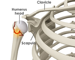 What is a Shoulder Fracture?