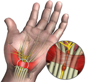 Carpal Tunnel Syndrome in Mesa, Chandler, Gilbert, Tempe, and Phoenix