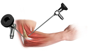 Elbow Arthroscopy