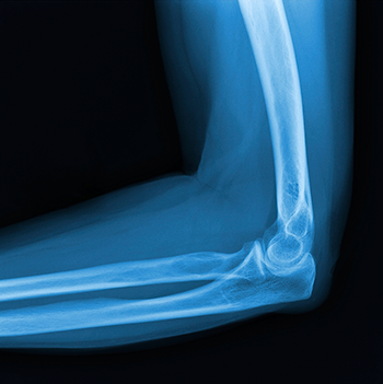 Elbow Arthritis Surgeon Chandler, AZ | Casa Grande | Hip Fracture Mesa ...