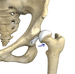 Causes of Hip Dislocation