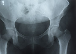 Diagnosis of Hip Pain