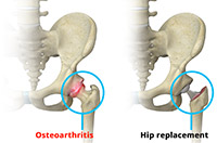 Management of Osteoarthritis of the Hip