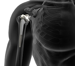 What is Reverse Total Shoulder Replacement?