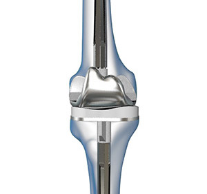 Revision Total Knee Replacement