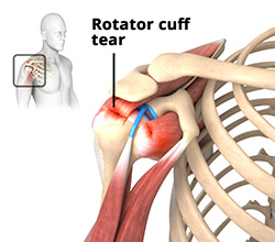 Rotator Cuff Surgery in Reno and Carson City