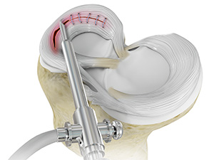 Surgical Treatment for Meniscal Tears