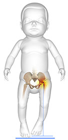 Symptoms Of Developmental Dysplasia