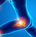 Symptoms of Hip Dislocation