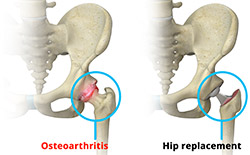 Hip Pain (Severe) - 2 X QF28-6, 1 X QF28-3