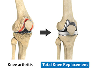 https://www.drmatanky.com/images/total-knee-replacement.jpg