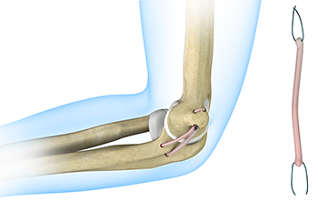 Ulnar Nerve Release Surgeon Chandler, AZ, Casa Grande