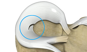 Meniscal Tears