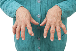 What are the Causes of Arthritis of the Hand and Wrist?