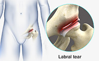 What is a Hip Labral Tear