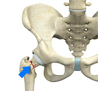 What is Hip Fracture Surgery