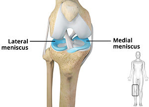 What is a Meniscal Tear