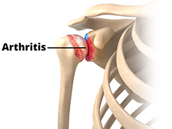 What is Osteoarthritis?