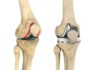 Total Knee Replacement